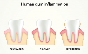 Is-Periodontal-Disease-Contagious