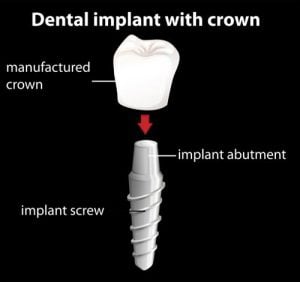 osseointegration