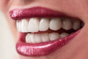 full smile with dental implants