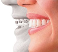 Illustration: Difference between visible metal braces and Invisalign