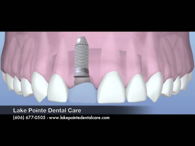 Dental Implants by Lake Pointe Dental Care (#2) Video Thumbnail